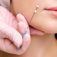 PDO Thread Lifts; What Results Can You Realistically Expect?