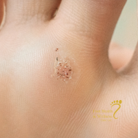 Corns vs Callus vs Verruca: How to Tell the Difference (and What to Do)